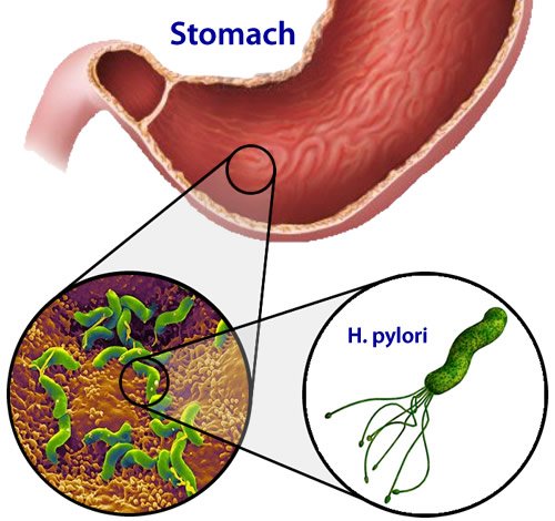infección por H. pylori